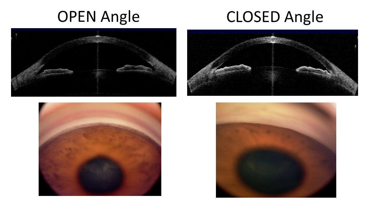 angle-closure-glaucoma