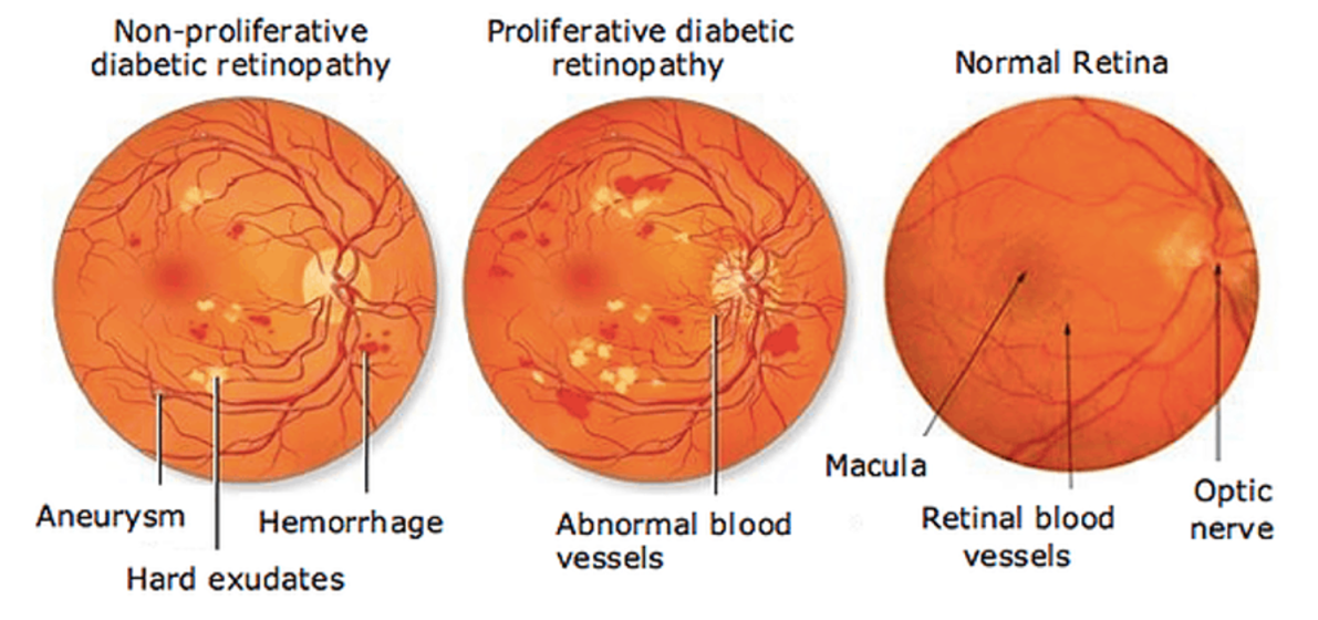 Diabetic Retinopathy | What is it, Causes and Treatment