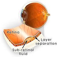 central serous retinopathy