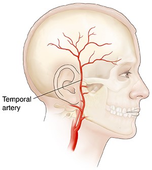 Giant cell arteritis